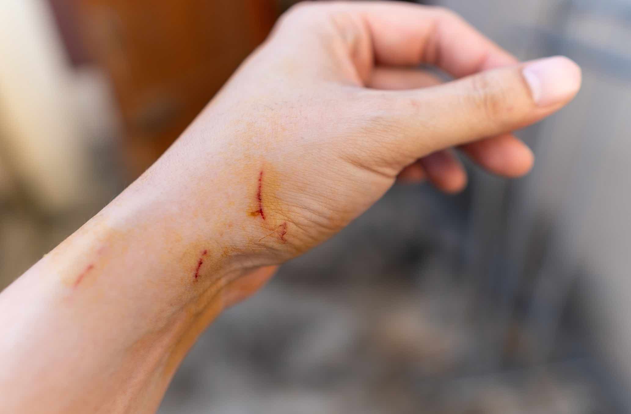 Bệnh sốt mèo cào